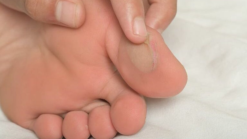 Tác hại của giày thể thao quá chật gây chai chân và khó chịu