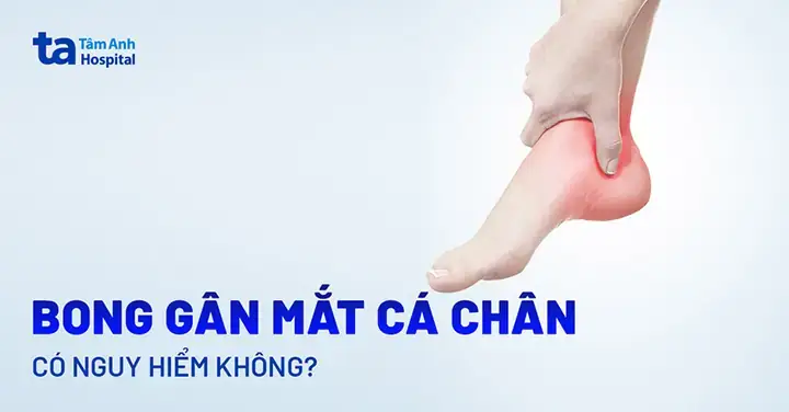 Bị Chệch Mắt Cá Chân Do Đi Giày Cao: Nguyên Nhân, Cách Xử Lý Và Phòng Ngừa Hiệu Quả