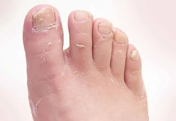 Cách Vệ Sinh Giày Đúng Cách Cho Người Bị Nấm Chân: Cẩm Nang Toàn Tập