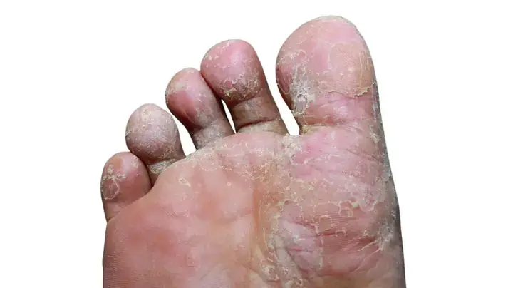 Cách Vệ Sinh Giày Đúng Cách Cho Người Bị Nấm Chân: Cẩm Nang Toàn Tập