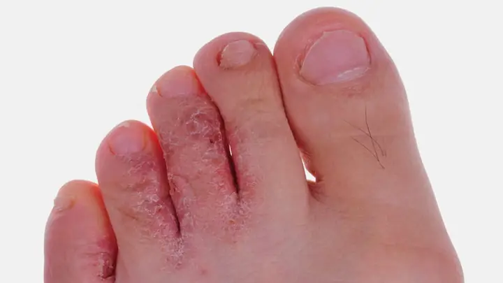 Cách Vệ Sinh Giày Đúng Cách Cho Người Bị Nấm Chân: Cẩm Nang Toàn Tập