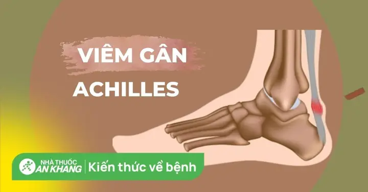 Chọn Giày Tennis Để Tránh Đau Gân Gót Chân
