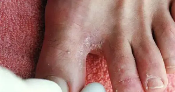 Đi Giày Bị Nước Ăn Chân Chữa Bằng Thuốc Gì? Hướng Dẫn Chi Tiết Từ A-z