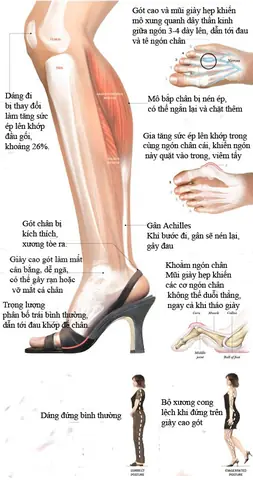 Đi Giày Cao Gót Có Nguy Hiểm Không?
